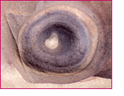 Erosions